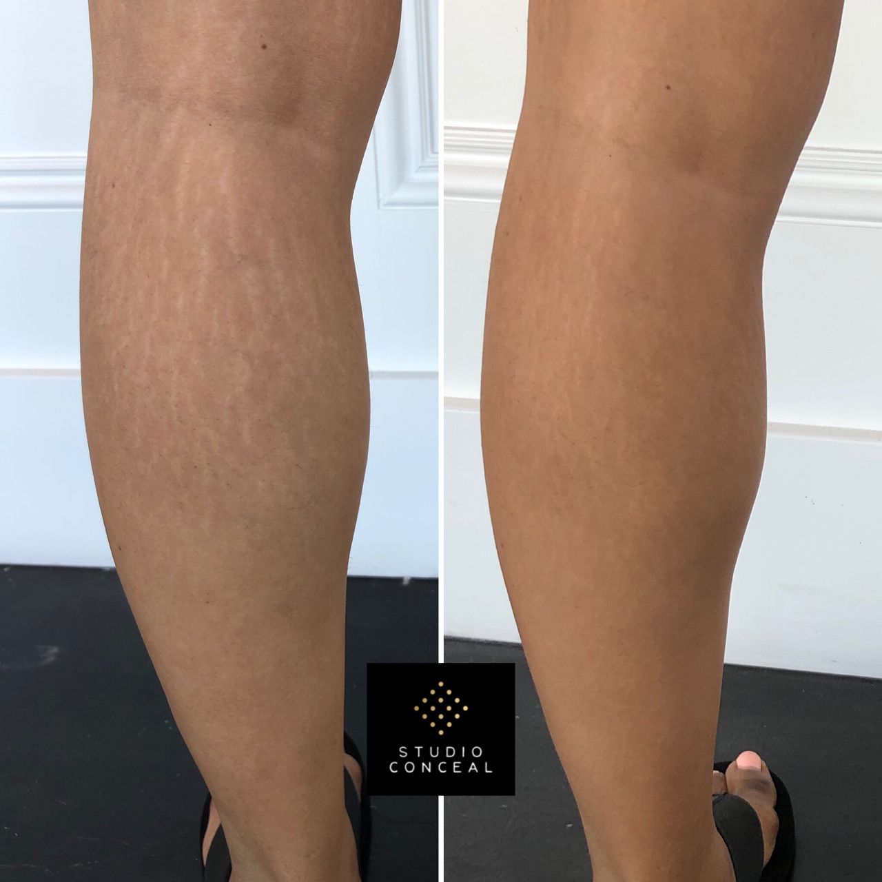 Alasan Anda Memiliki Stretch Marks